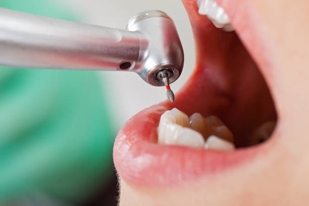 Best Emergency Tooth Extraction in Council Grove, KS